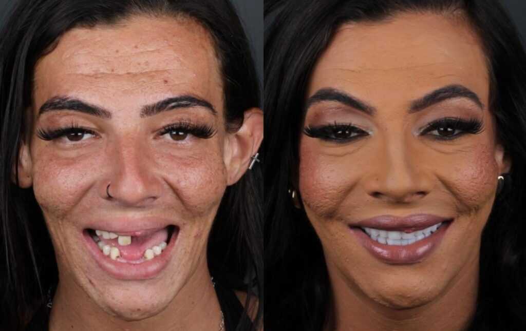 clinica-de-santa-barbara-transforma-sorriso-de-casal-quem-morava-na-rua